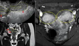 Dolor pélvico agudo y sangrado en adolescente: Resonancia revela útero doble y agenesia renal ipsilateral