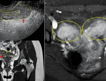 Dolor pélvico agudo y sangrado en adolescente: Resonancia revela útero doble y agenesia renal ipsilateral