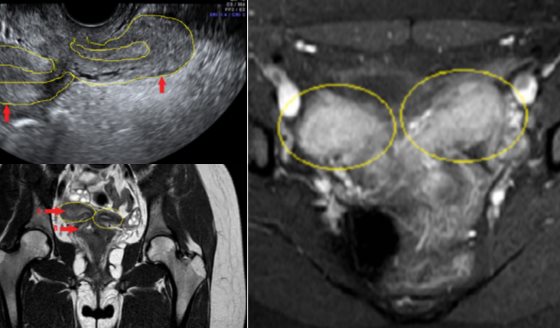 Dolor pélvico agudo y sangrado en adolescente: Resonancia revela útero doble y agenesia renal ipsilateral