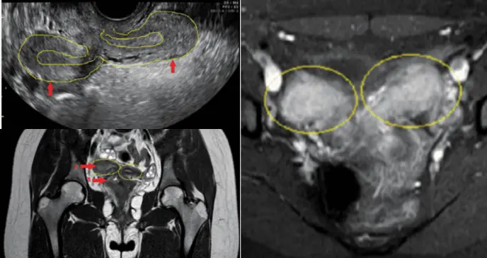 Dolor pélvico agudo y sangrado en adolescente: Resonancia revela útero doble y agenesia renal ipsilateral