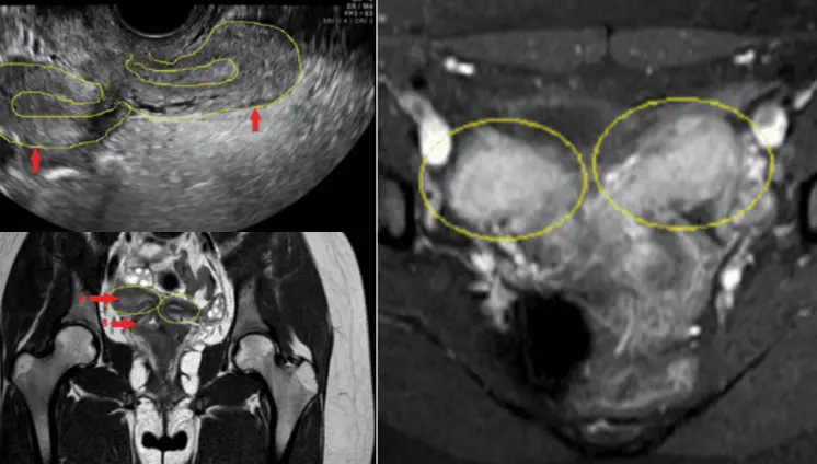 Dolor pélvico agudo y sangrado en adolescente: Resonancia revela útero doble y agenesia renal ipsilateral