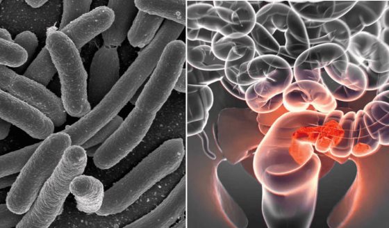 Estudio revelador vincula bacteria intestinal con aumento alarmante de cáncer de colon en jóvenes  
