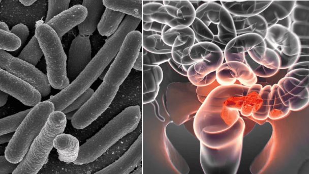 Estudio revelador vincula bacteria intestinal con aumento alarmante de cáncer de colon en jóvenes  