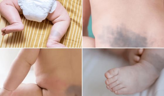 ¿Qué es la mancha de Baltz? Lesión cutánea benigna azulada y común en recién nacidos