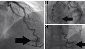 Fístula coronaria como causa inusual de infarto miocárdico en paciente sin enfermedad coronaria