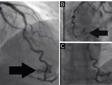 Fístula coronaria como causa inusual de infarto miocárdico en paciente sin enfermedad coronaria