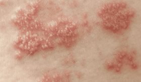 EE.UU incluye el herpes en su Plan Nacional contra las ITS para mejorar la prevención y tratamiento