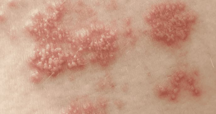 EE.UU incluye el herpes en su Plan Nacional contra las ITS para mejorar la prevención y tratamiento