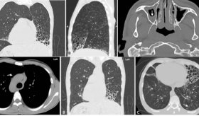 Tos, sinusitis y bronquiectasia como manifestaciones del síndrome de Kartagener en paciente con epilepsia