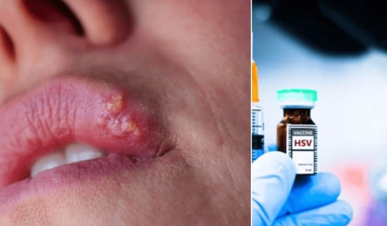 Nuevas vacunas de ARNm terapéuticas y preventivas para el Herpes Simple: Mayor efectividad y duración
