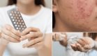 Ciclos irregulares, caída de cabello y acné severo: síntomas del síndrome post-anticonceptivo