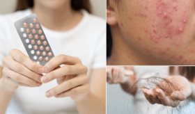 Ciclos irregulares, caída de cabello y acné severo: síntomas del síndrome post-anticonceptivo