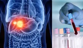 Análisis de sangre podría predecir enfermedad de hígado graso con 16 años de anticipación