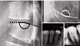 Pérdida de estatura y fracturas costales por tos como manifestaciones iniciales de osteoporosis