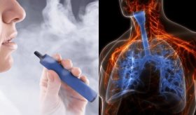 Confirman bronquiolitis obliterante en joven de 17 años por uso prolongado de cigarrillos electrónicos