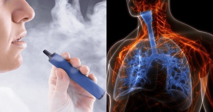 Confirman bronquiolitis obliterante en joven de 17 años por uso prolongado de cigarrillos electrónicos