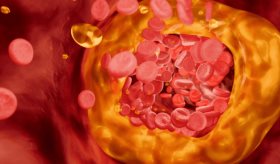Nueva prueba de colesterol malo que evalúa el riesgo cardiovascular, supera a pruebas tradicionales  