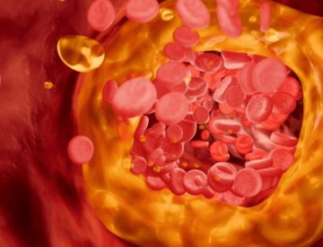 Nueva prueba de colesterol malo que evalúa el riesgo cardiovascular, supera a pruebas tradicionales  