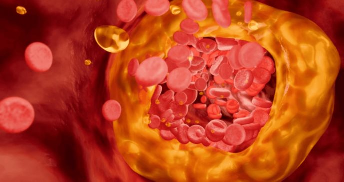 Nueva prueba de colesterol malo que evalúa el riesgo cardiovascular, supera a pruebas tradicionales  