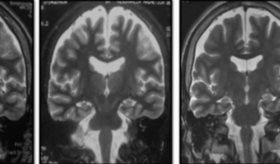 Síndrome FIRES causa estado epiléptico superrefractario con evolución a epilepsia farmacorresistente