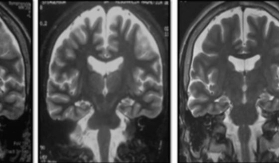 Síndrome FIRES causa estado epiléptico superrefractario con evolución a epilepsia farmacorresistente