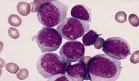 Prueba de médula ósea podría duplicar la supervivencia en jóvenes con leucemia mieloide aguda