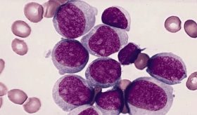 Prueba de médula ósea podría duplicar la supervivencia en jóvenes con leucemia mieloide aguda