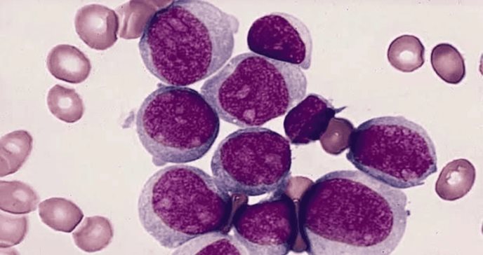 Prueba de médula ósea podría duplicar la supervivencia en jóvenes con leucemia mieloide aguda