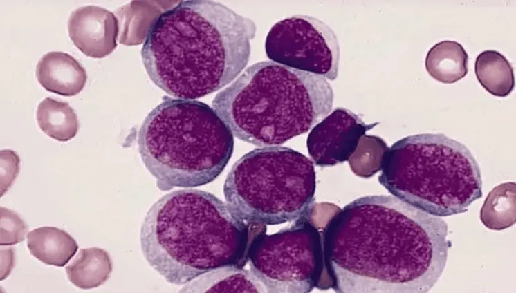 Prueba de médula ósea podría duplicar la supervivencia en jóvenes con leucemia mieloide aguda