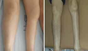 Debilidad progresiva y fatiga muscular en adultos mayores como indicadores clínicos de síndrome postpolio