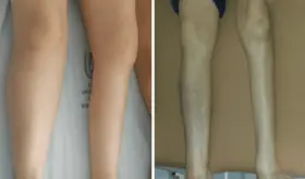 Debilidad progresiva y fatiga muscular en adultos mayores como indicadores cl&iacute;nicos de s&iacute;ndrome postpolio