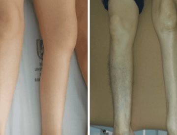 Debilidad progresiva y fatiga muscular en adultos mayores como indicadores clínicos de síndrome postpolio