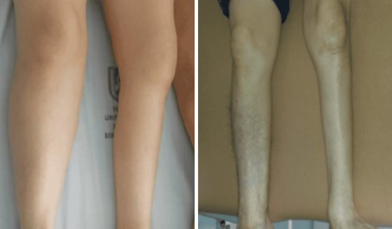 Debilidad progresiva y fatiga muscular en adultos mayores como indicadores clínicos de síndrome postpolio