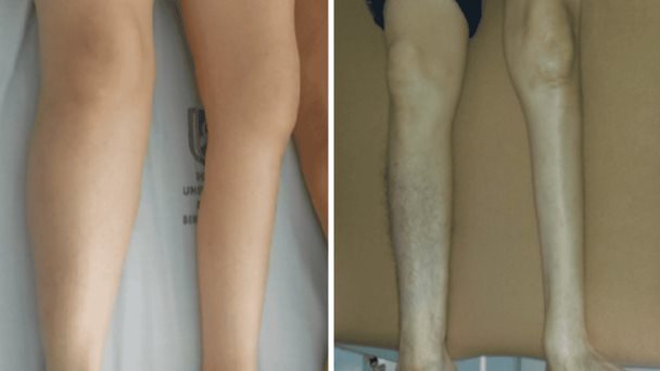 Debilidad progresiva y fatiga muscular en adultos mayores como indicadores clínicos de síndrome postpolio Debilidad progresiva y fatiga muscular en adultos mayores como indicadores clínicos de síndrome postpolio