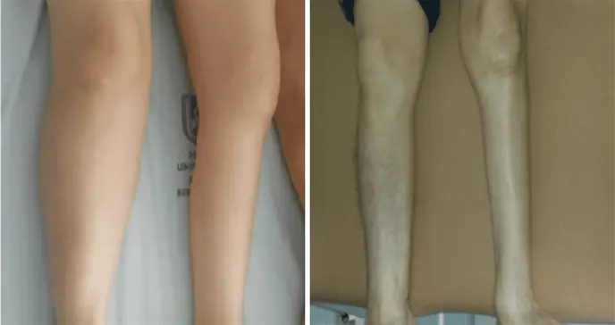 Debilidad progresiva y fatiga muscular en adultos mayores como indicadores clínicos de síndrome postpolio Debilidad progresiva y fatiga muscular en adultos mayores como indicadores clínicos de síndrome postpolio