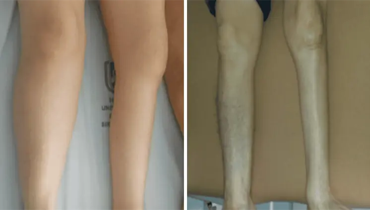 Debilidad progresiva y fatiga muscular en adultos mayores como indicadores clínicos de síndrome postpolio Debilidad progresiva y fatiga muscular en adultos mayores como indicadores clínicos de síndrome postpolio