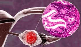 Descubren células NK adaptativas con memoria: reconocen el cáncer de ovario y lo atacan con más eficacia