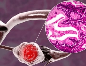 Descubren células NK adaptativas con memoria: reconocen el cáncer de ovario y lo atacan con más eficacia