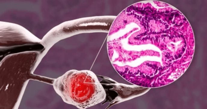 Descubren células NK adaptativas con memoria: reconocen el cáncer de ovario y lo atacan con más eficacia