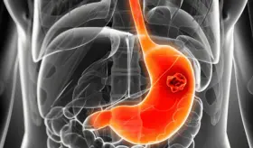 Cáncer gástrico: Identifican mutaciones genéticas que podrían indicar el nivel de agresividad del tumor