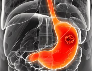 Cáncer gástrico: Identifican mutaciones genéticas que podrían indicar el nivel de agresividad del tumor