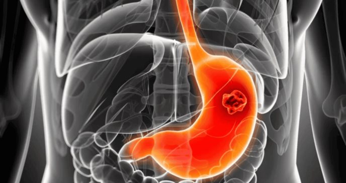 Cáncer gástrico: Identifican mutaciones genéticas que podrían indicar el nivel de agresividad del tumor