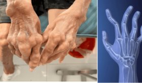 Programa de educación entre pares mejora adherencia al tratamiento en pacientes con artritis reumatoide