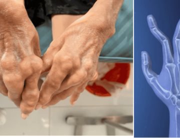 Programa de educación entre pares mejora adherencia al tratamiento en pacientes con artritis reumatoide