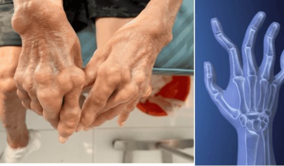 Programa de educación entre pares mejora adherencia al tratamiento en pacientes con artritis reumatoide