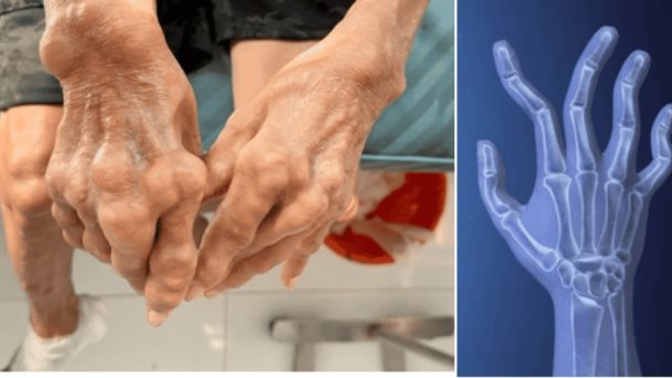 Programa de educación entre pares mejora adherencia al tratamiento en pacientes con artritis reumatoide Programa de educación entre pares mejora adherencia al tratamiento en pacientes con artritis reumatoide