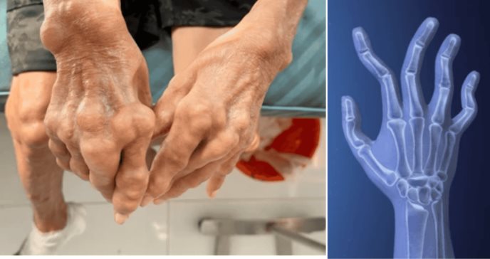 Programa de educación entre pares mejora adherencia al tratamiento en pacientes con artritis reumatoide