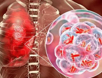 Fármaco navitoclax contra el cáncer podría mejorar el tratamiento de la tuberculosis, según estudio