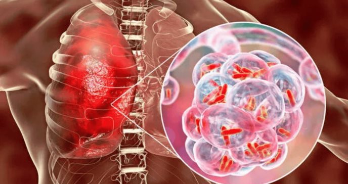 Fármaco navitoclax contra el cáncer podría mejorar el tratamiento de la tuberculosis, según estudio