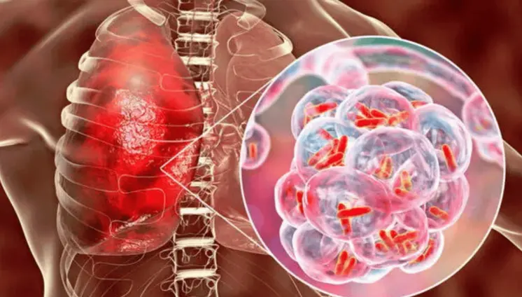 Fármaco navitoclax contra el cáncer podría mejorar el tratamiento de la tuberculosis, según estudio